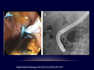 Gastrointest Endoscopy Clin N Am 23 (2013) 251–275
 