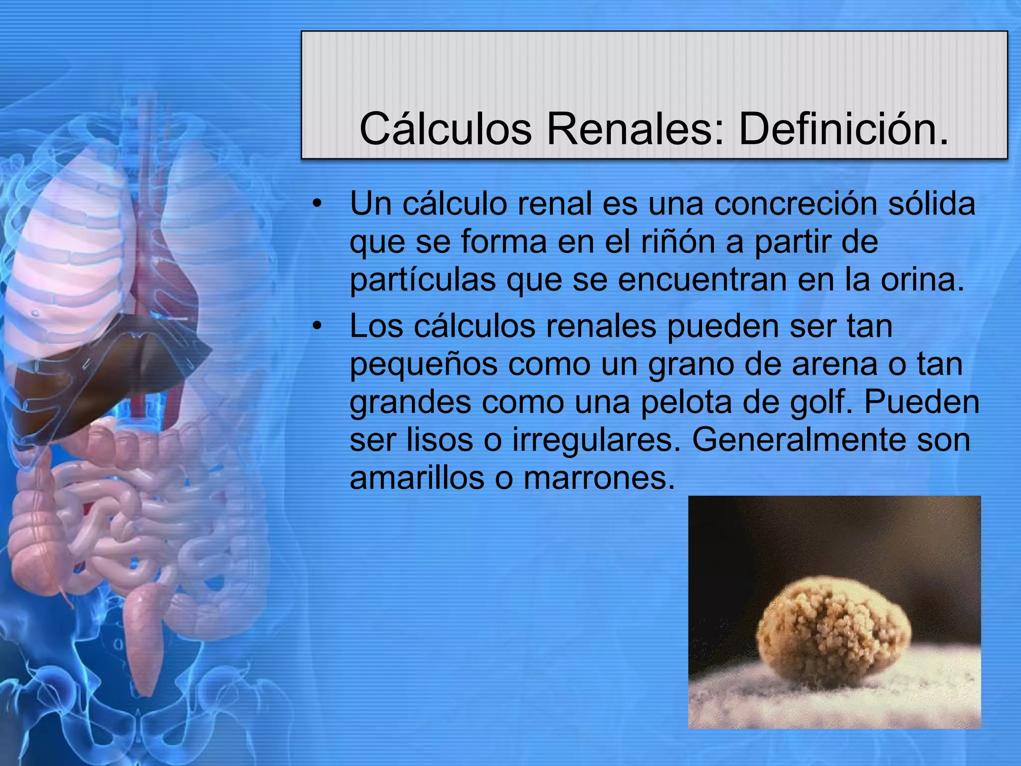 Calculos Biliares Y Calculos Renales | PPT