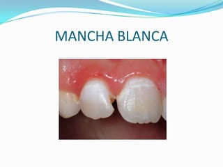 MANCHA BLANCA