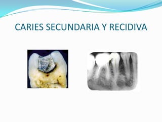 CARIES SECUNDARIA Y RECIDIVA