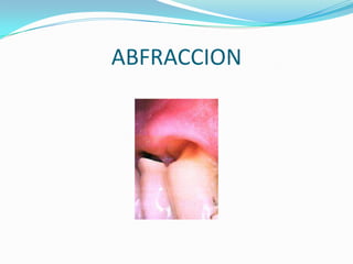 ABFRACCION
