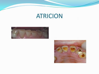 ATRICION