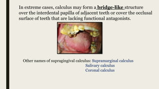 Calaculus Bridge Calculus | PPTX