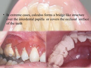 Calculus- Calcification of the plaque maturation | PPTX