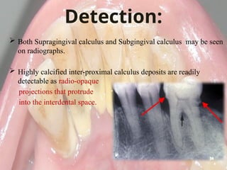 Calculus- Calcification of the plaque maturation | PPTX