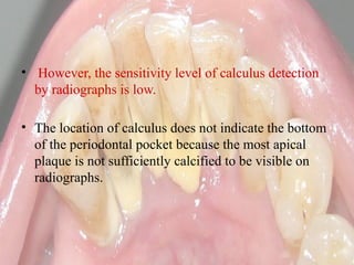 Calculus- Calcification of the plaque maturation | PPTX