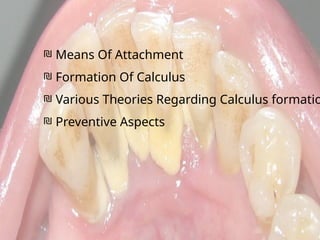 Calculus- Calcification of the plaque maturation | PPTX