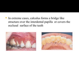calculus in periodontics power point presentation | PPT