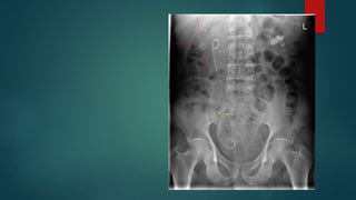 Calculus Disease Renal Stones Radiology | PPTX