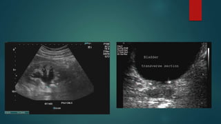 Calculus Disease Renal Stones Radiology | PPTX