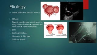 Calculus Disease Renal Stones Radiology | PPTX