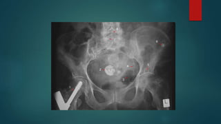 Calculus Disease Renal Stones Radiology | PPTX