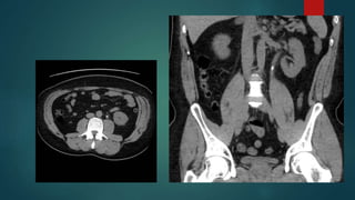 Calculus Disease Renal Stones Radiology | PPTX