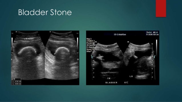 Calculus Disease Renal Stones Radiology