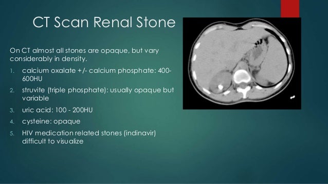 Indinavir stones radiology