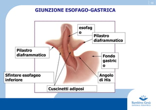 16
esofag
o
Pilastro
diaframmatico Fondo
gastric
o
Angolo
di His
Cuscinetti adiposi
Pilastro
diaframmatico
Sfintere esofageo
inferiore
GIUNZIONE ESOFAGO-GASTRICA
 