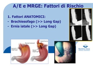 A/E e MRGE: Fattori di Rischio
1.  Fattori ANATOMICI:
- Brachiesofago (>> Long Gap)
- Ernia iatale (>> Long Gap)
 