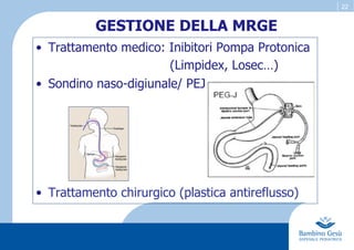 22
GESTIONE DELLA MRGE
•  Trattamento medico: Inibitori Pompa Protonica
(Limpidex, Losec…)
•  Sondino naso-digiunale/ PEJ
•  Trattamento chirurgico (plastica antireflusso)
 