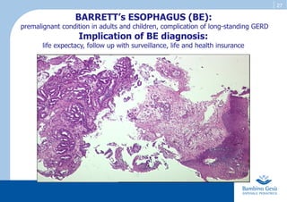 27
BARRETT’s ESOPHAGUS (BE):
premalignant condition in adults and children, complication of long-standing GERD
Implication of BE diagnosis:
life expectacy, follow up with surveillance, life and health insurance
 