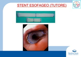 8
STENT ESOFAGEO (TUTORE)
 