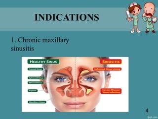 INDICATIONS
1. Chronic maxillary
sinusitis
4
 