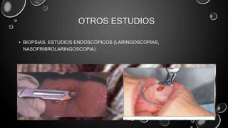 OTROS ESTUDIOS
• BIOPSIAS. ESTUDIOS ENDOSCÓPICOS (LARINGOSCOPIAS,
NASOFRIBROLARINGOSCOPIA).
 