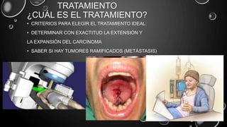 TRATAMIENTO
¿CUÁL ES EL TRATAMIENTO?
• CRITERIOS PARA ELEGIR EL TRATAMIENTO IDEAL:
• DETERMINAR CON EXACTITUD LA EXTENSIÓN Y
LA EXPANSIÓN DEL CARCINOMA
• SABER SI HAY TUMORES RAMIFICADOS (METÁSTASIS)
 