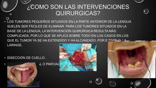 ¿COMO SON LAS INTERVENCIONES
QUIRURGICAS?
• LOS TUMORES PEQUEÑOS SITUADOS EN LA PARTE ANTERIOR DE LA LENGUA
SUELEN SER FÁCILES DE ELIMINAR. PARA LOS TUMORES SITUADOS EN LA
BASE DE LA LENGUA, LA INTERVENCIÓN QUIRÚRGICA RESULTA MÁS
COMPLICADA, POR LO QUE SE APLICA SOBRE TODO EN LOS CASOS EN LOS
QUE EL TUMOR YA SE HA EXTENDIDO Y HA ALCANZADO, POR EJEMPLO, LA
LARINGE.
• DISECCIÓN DE CUELLO.
• GLOSECTOMÍA TOTAL O PARCIAL.
 