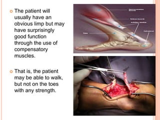  The patient will
usually have an
obvious limp but may
have surprisingly
good function
through the use of
compensatory
muscles.
 That is, the patient
may be able to walk,
but not on the toes
with any strength.
 