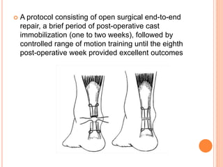  A protocol consisting of open surgical end-to-end
repair, a brief period of post-operative cast
immobilization (one to two weeks), followed by
controlled range of motion training until the eighth
post-operative week provided excellent outcomes
 