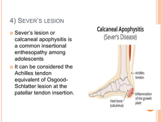 4) SEVER’S LESION
 Sever’s lesion or
calcaneal apophysitis is
a common insertional
enthesopathy among
adolescents
 It can be considered the
Achilles tendon
equivalent of Osgood-
Schlatter lesion at the
patellar tendon insertion.
 