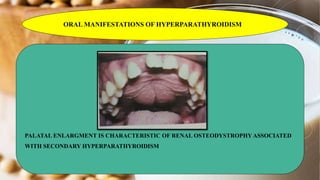 ORAL MANIFESTATIONS OF HYPERPARATHYROIDISM
PALATAL ENLARGMENT IS CHARACTERISTIC OF RENAL OSTEODYSTROPHY ASSOCIATED
WITH SECONDARY HYPERPARATHYROIDISM
 
