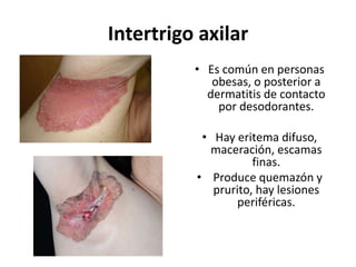 Intertrigo axilar
• Es común en personas
obesas, o posterior a
dermatitis de contacto
por desodorantes.
• Hay eritema difuso,
maceración, escamas
finas.
• Produce quemazón y
prurito, hay lesiones
periféricas.
 