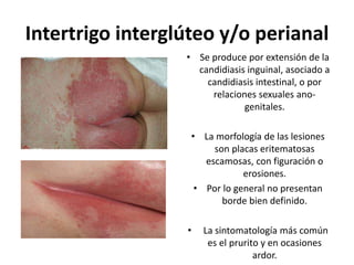 Intertrigo interglúteo y/o perianal
• Se produce por extensión de la
candidiasis inguinal, asociado a
candidiasis intestinal, o por
relaciones sexuales ano-
genitales.
• La morfología de las lesiones
son placas eritematosas
escamosas, con figuración o
erosiones.
• Por lo general no presentan
borde bien definido.
• La sintomatología más común
es el prurito y en ocasiones
ardor.
 