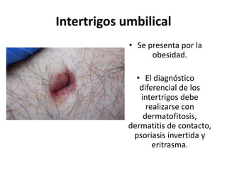 Intertrigos umbilical
• Se presenta por la
obesidad.
• El diagnóstico
diferencial de los
intertrigos debe
realizarse con
dermatofitosis,
dermatitis de contacto,
psoriasis invertida y
eritrasma.
 
