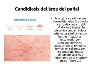 Candidiasis del área del pañal
• Se origina a partir de una
dermatitis del pañal, afecta
la zona de contacto del
pañal y los pliegues. Se
presenta como una placa
eritematosa, brillante, con
bordes irregulares,
festoneado, con
componente vésico-
pustular que al romperse
forman un collarete con
lesiones satélites. La
sintomatología más
importante en el prurito y
ardor. (Figura 29)
 