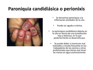 Paroniquia candidiásica o perionixis
• Se denomina paroniquia a la
inflamación alrededor de la uña.
• Puede ser aguda o crónica.
• La paroniquia candidiásica debuta en
la uña en forma de una tumefacción
roja y dolorosa, en la que
posteriormente se desarrolla pus.
• Se puede deber a manicuras mal
realizadas y resulta frecuente en los
trabajadores de las cocinas y otros
profesionales que tienen que tener
las manos en agua continuamente.
 