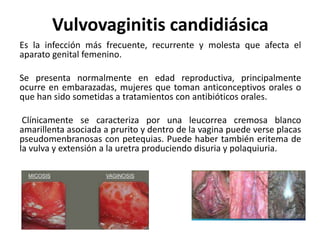 Vulvovaginitis candidiásica
Es la infección más frecuente, recurrente y molesta que afecta el
aparato genital femenino.
Se presenta normalmente en edad reproductiva, principalmente
ocurre en embarazadas, mujeres que toman anticonceptivos orales o
que han sido sometidas a tratamientos con antibióticos orales.
Clínicamente se caracteriza por una leucorrea cremosa blanco
amarillenta asociada a prurito y dentro de la vagina puede verse placas
pseudomenbranosas con petequias. Puede haber también eritema de
la vulva y extensión a la uretra produciendo disuria y polaquiuria.
 