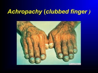 Achropachy (clubbed finger )
 