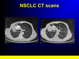 NSCLC CT scans
 
