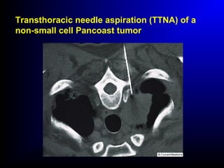 Transthoracic needle aspiration (TTNA) of a
non-small cell Pancoast tumor
 