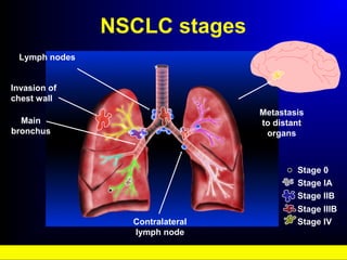 NSCLC stages
Stage 0
Stage IA
Stage IIB
Stage IIIB
Stage IV
Lymph nodes
Main
bronchus
Contralateral
lymph node
Metastasis
to distant
organs
Invasion of
chest wall
 
