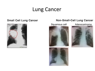 Lung Cancer
Small Cell Lung Cancer Non-Small-Cell Lung Cancer
Squamous cell Adenocarinoma
 