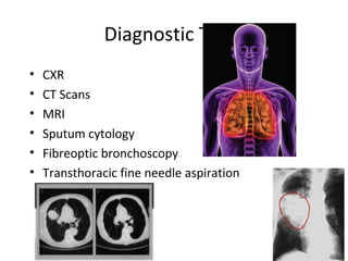 Diagnostic Tests
• CXR
• CT Scans
• MRI
• Sputum cytology
• Fibreoptic bronchoscopy
• Transthoracic fine needle aspiration
 