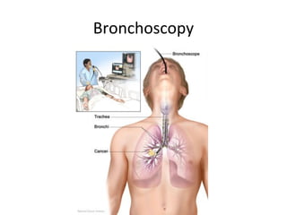 Bronchoscopy
 