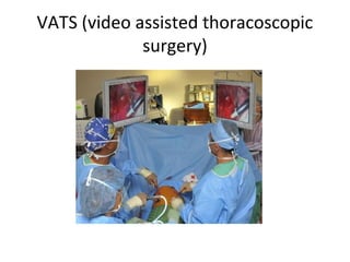 VATS (video assisted thoracoscopic
surgery)
 