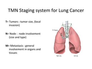 TMN Staging system for Lung Cancer
T= Tumors : tumor size, (local
invasion)
N= Node : node involvement
(size and type)
M= Metastasis : general
involvement in organs and
tissues
 