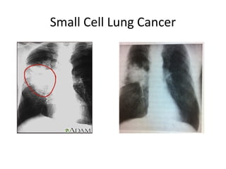 Small Cell Lung Cancer
 