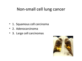 Non-small cell lung cancer
• 1. Squamous cell carcinoma
• 2. Adenocarcinoma
• 3. Large cell carcinomas
 