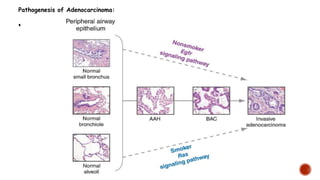 •
Pathogenesis of Adenocarcinoma:
•
 